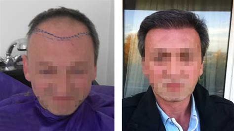 hermest hair transplant reviews